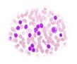 Leucemia linfoblástica aguda