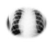 Linfoma de Hodgkin