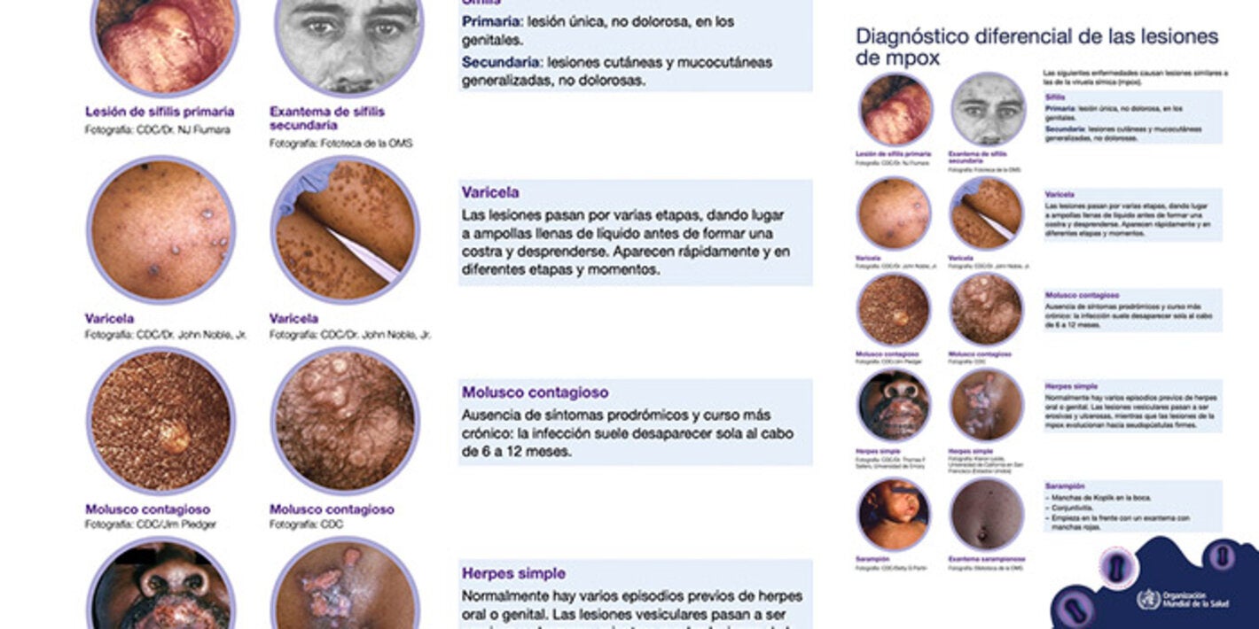 diagnostico diferencial mpox
